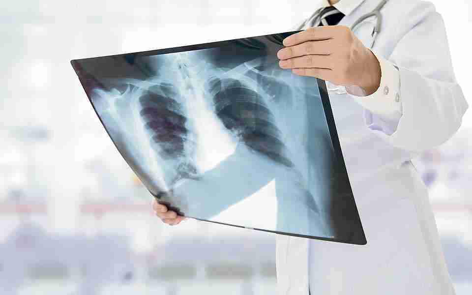 Fibrosis Pulmonar, un asesino silencioso